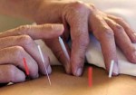 acupuntura-maceio-1400172072